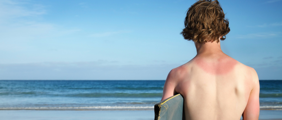 Sunburned? What to Do if You Get Too Much Sun Lancaster General Hospital